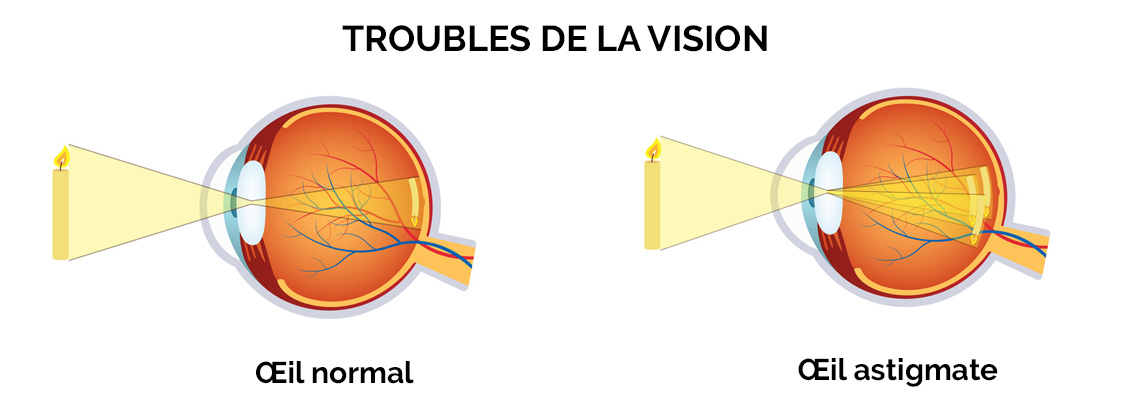 symptomes-astigmatisme-lentilles contact